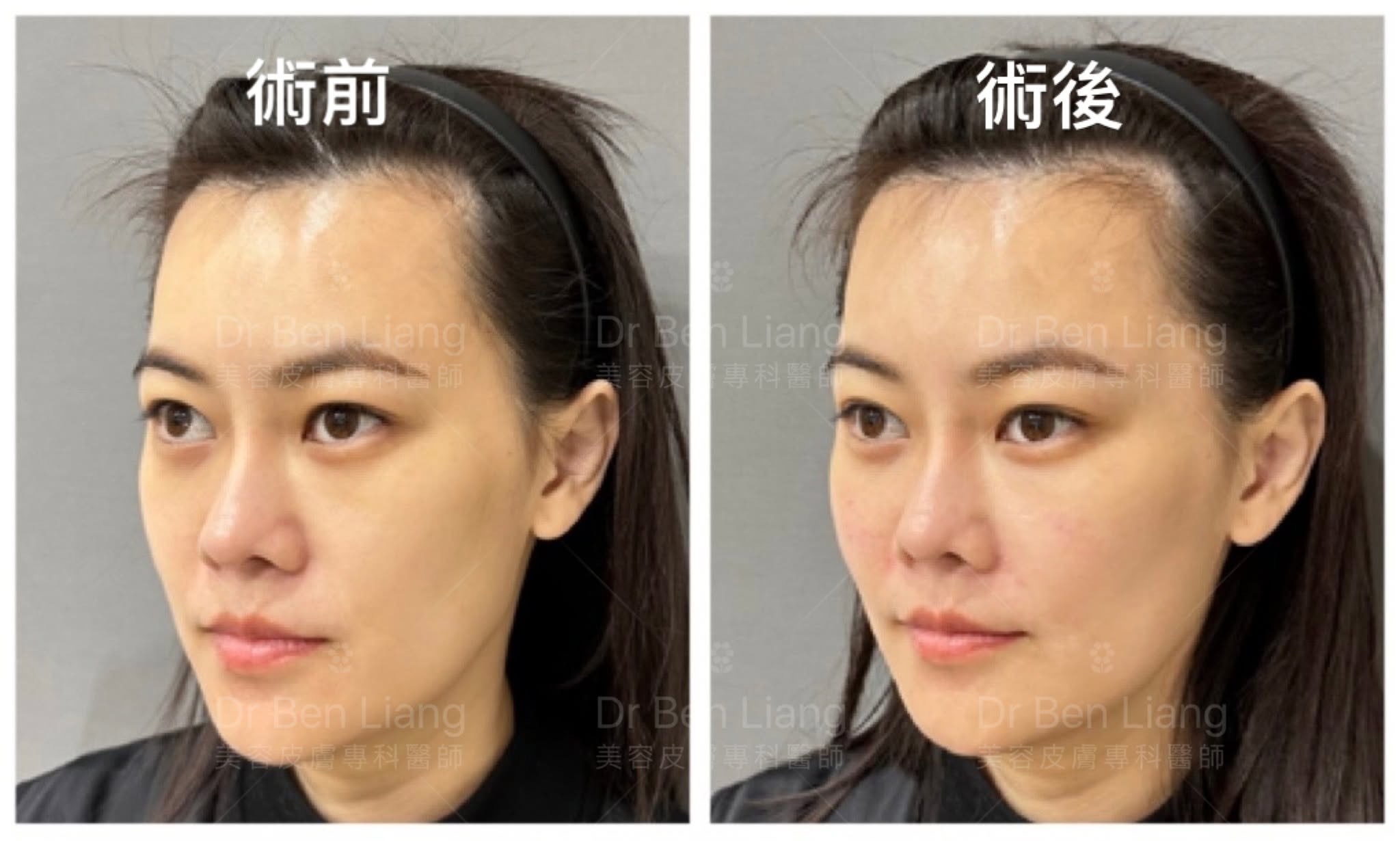 術前術後比較與手把手尖針課程案例